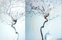 Digital Subtraction Angiography (DSA) - Razi Hospital